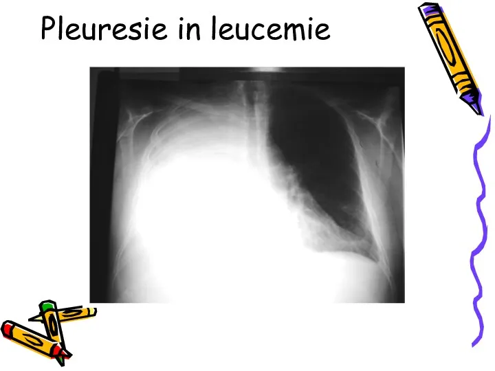 Pleuresie in leucemie