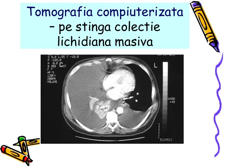 Tomografia compiuterizata – pe stinga colectie lichidiana masiva