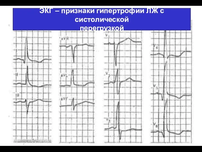 (По М.Фриду и С.Грайнсу (1996), Харрисону(1995) ЭКГ – признаки гипертрофии ЛЖ с систолической перегрузкой