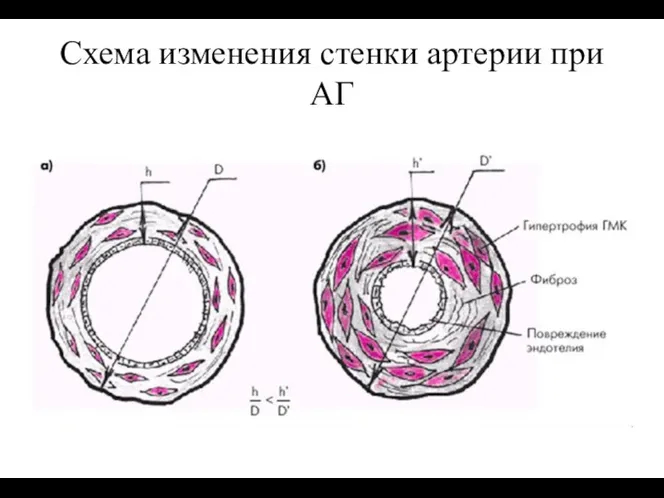 Схема изменения стенки артерии при АГ