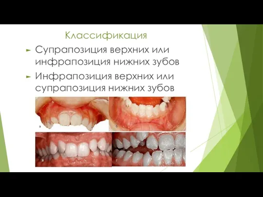 Классификация Супрапозиция верхних или инфрапозиция нижних зубов Инфрапозиция верхних или супрапозиция нижних зубов