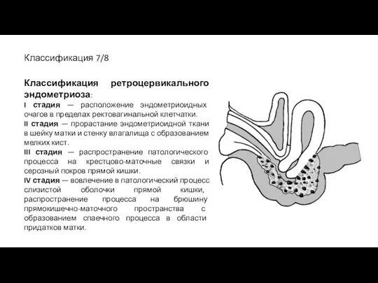 Классификация 7/8 Классификация ретроцервикального эндометриоза: I стадия — расположение эндометриоидных