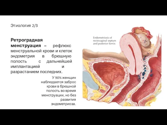 Этиология 2/3 Ретроградная менструация – рефлюкс менструальной крови и клеток