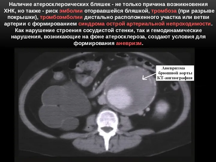 Наличие атеросклероических бляшек - не только причина возникновения ХНК, но