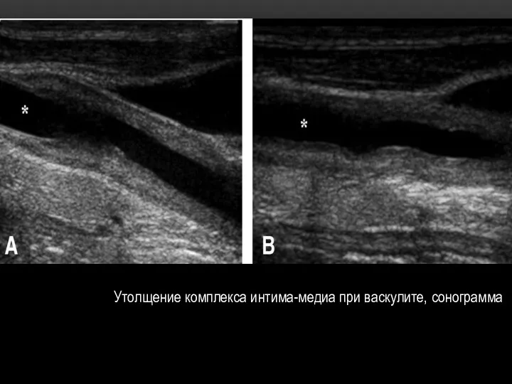 Утолщение комплекса интима-медиа при васкулите, сонограмма