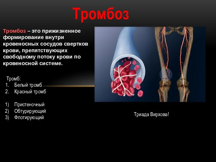 Тромбоз Тромбоз – это прижизненное формирование внутри кровеносных сосудов свертков