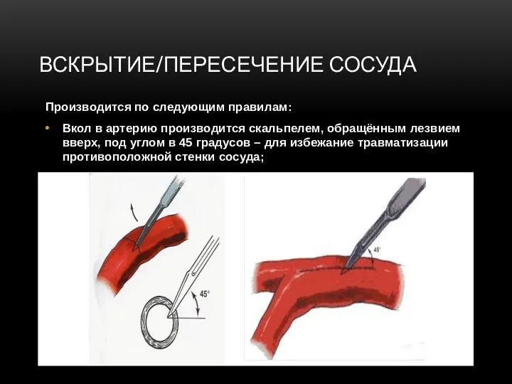 ВСКРЫТИЕ/ПЕРЕСЕЧЕНИЕ СОСУДА Производится по следующим правилам: Вкол в артерию производится