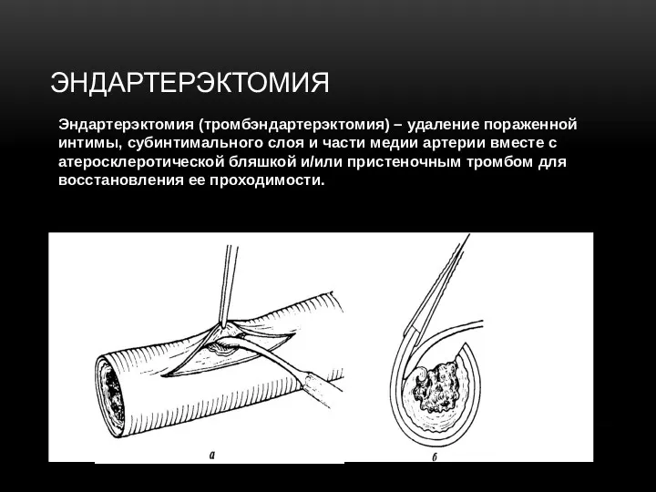 ЭНДАРТЕРЭКТОМИЯ Эндартерэктомия (тромбэндартерэктомия) – удаление пораженной интимы, субинтимального слоя и