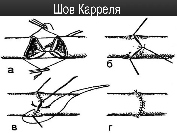 Шов Карреля