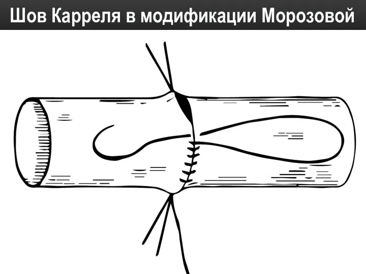 Шов Карреля в модификации Морозовой