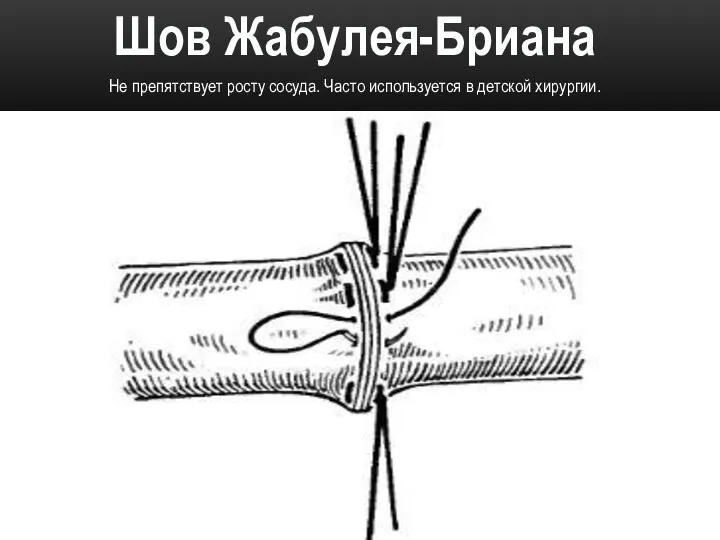 Шов Жабулея-Бриана Не препятствует росту сосуда. Часто используется в детской хирургии.