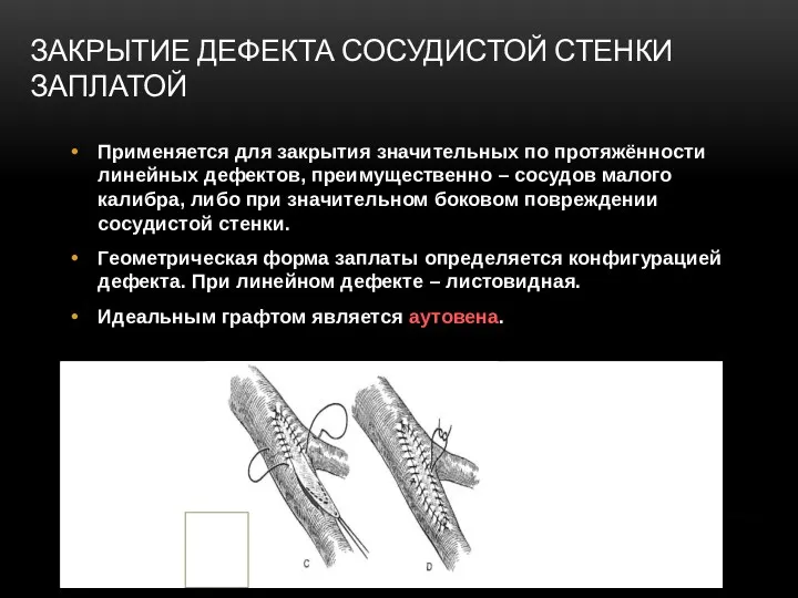 ЗАКРЫТИЕ ДЕФЕКТА СОСУДИСТОЙ СТЕНКИ ЗАПЛАТОЙ Применяется для закрытия значительных по