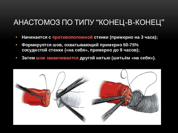 АНАСТОМОЗ ПО ТИПУ “КОНЕЦ-В-КОНЕЦ” Начинается с противоположной стенки (примерно на