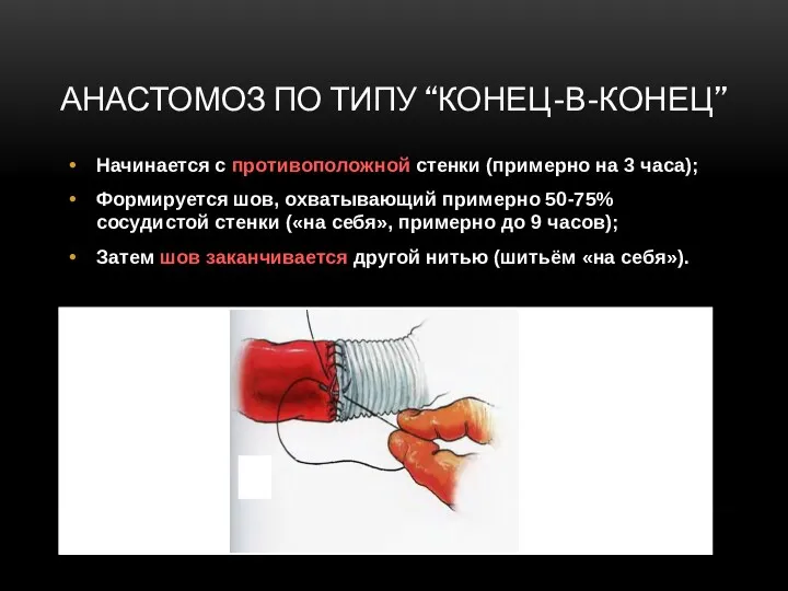 АНАСТОМОЗ ПО ТИПУ “КОНЕЦ-В-КОНЕЦ” Начинается с противоположной стенки (примерно на