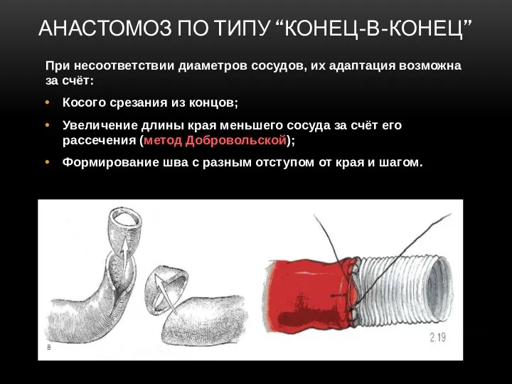 АНАСТОМОЗ ПО ТИПУ “КОНЕЦ-В-КОНЕЦ” При несоответствии диаметров сосудов, их адаптация