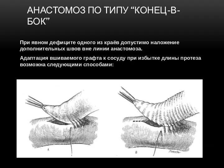 АНАСТОМОЗ ПО ТИПУ “КОНЕЦ-В-БОК” При явном дефиците одного из краёв