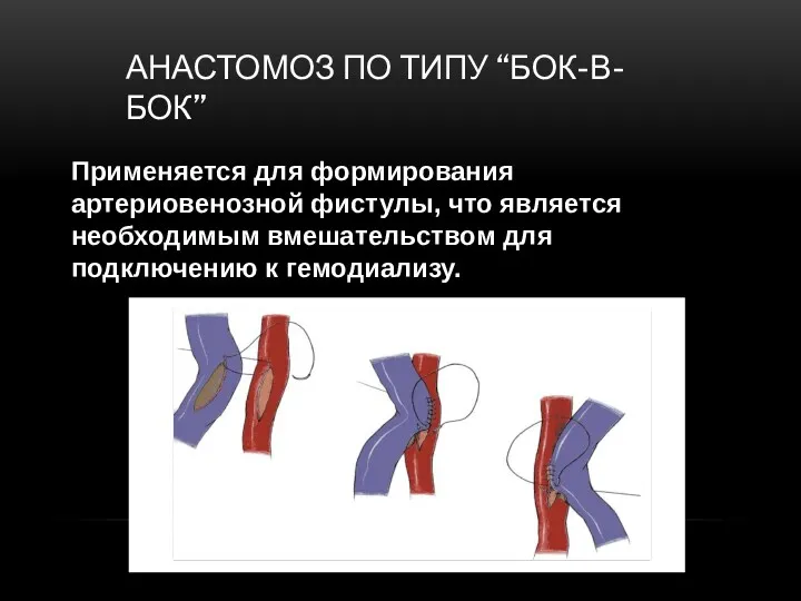 АНАСТОМОЗ ПО ТИПУ “БОК-В-БОК” Применяется для формирования артериовенозной фистулы, что