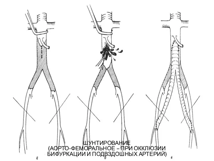 ШУНТИРОВАНИЕ (АОРТО-ФЕМОРАЛЬНОЕ – ПРИ ОККЛЮЗИИ БИФУРКАЦИИ И ПОДВЗДОШНЫХ АРТЕРИЙ)