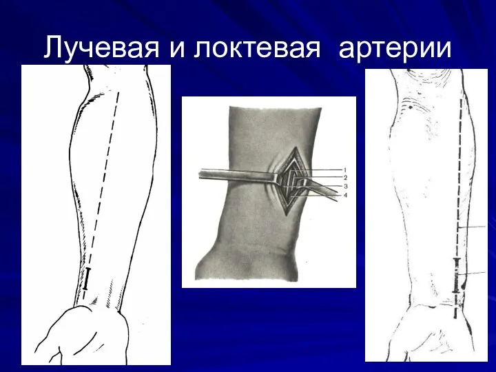 Лучевая и локтевая артерии