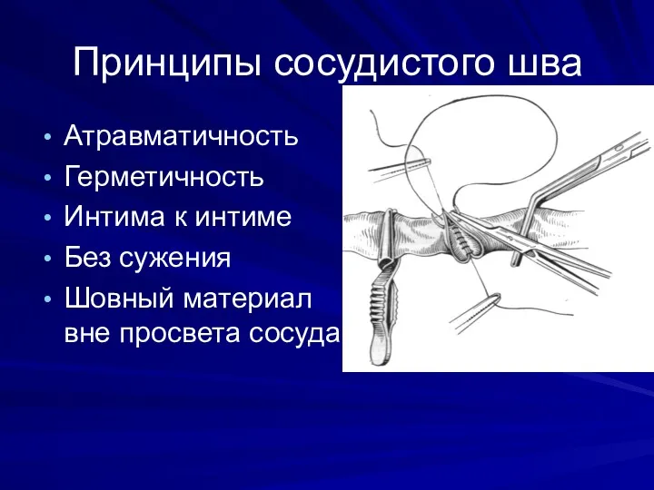 Принципы сосудистого шва Атравматичность Герметичность Интима к интиме Без сужения Шовный материал вне просвета сосуда