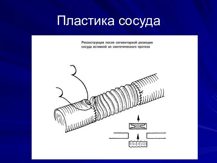 Пластика сосуда