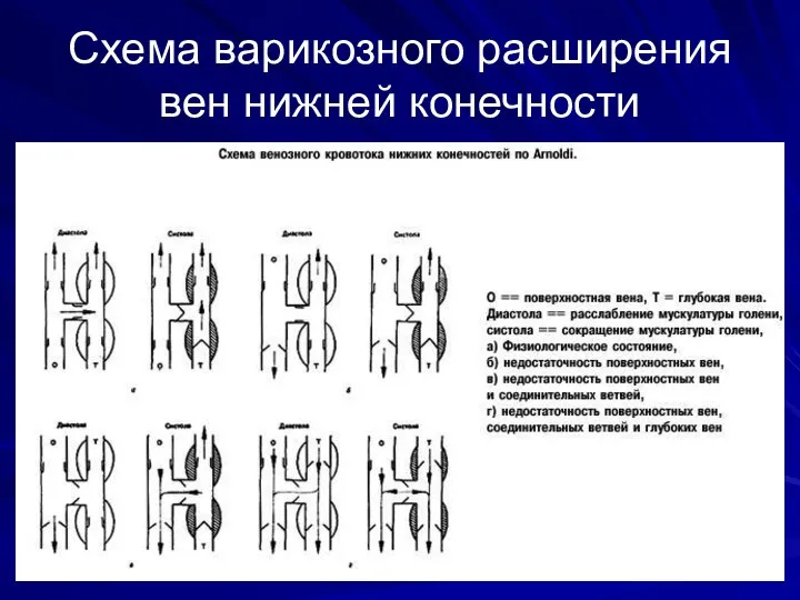 Схема варикозного расширения вен нижней конечности