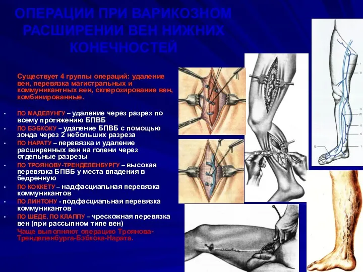ОПЕРАЦИИ ПРИ ВАРИКОЗНОМ РАСШИРЕНИИ ВЕН НИЖНИХ КОНЕЧНОСТЕЙ Существует 4 группы операций: удаление вен,