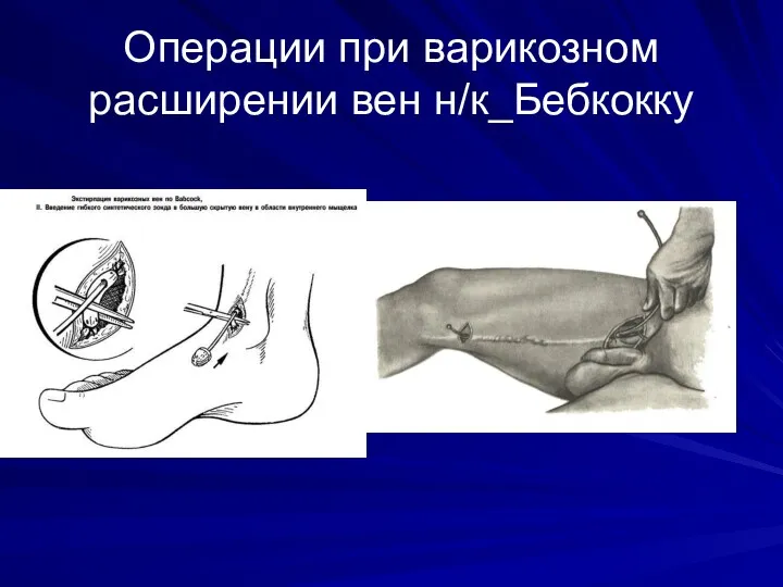 Операции при варикозном расширении вен н/к_Бебкокку