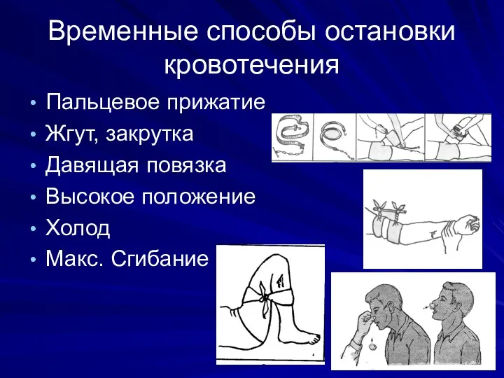 Временные способы остановки кровотечения Пальцевое прижатие Жгут, закрутка Давящая повязка Высокое положение Холод Макс. Сгибание