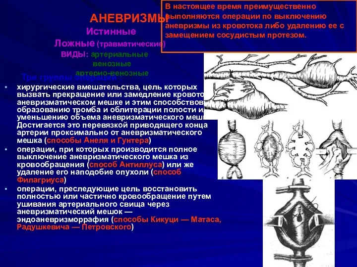 АНЕВРИЗМЫ Истинные Ложные (травматические) ВИДЫ: артериальные венозные артерио-венозные Три группы операций : хирургические