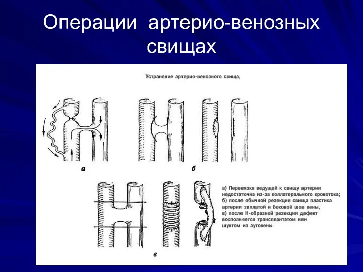 Операции артерио-венозных свищах