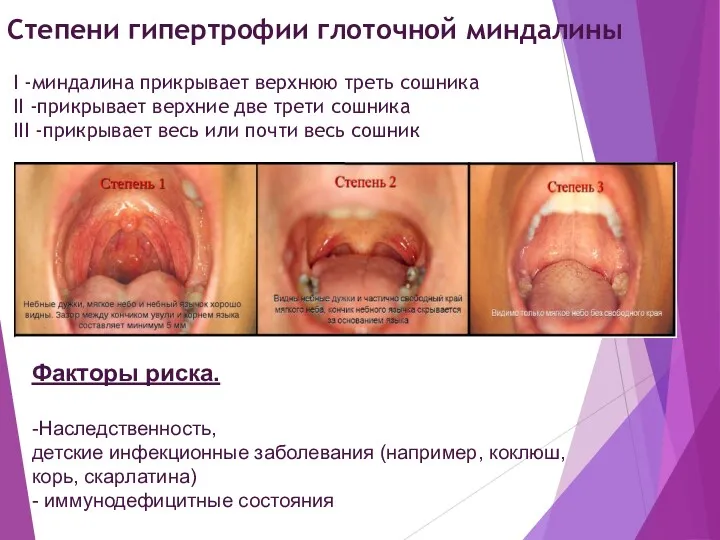 Степени гипертрофии глоточной миндалины I -миндалина прикрывает верхнюю треть сошника