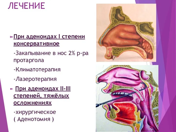 ЛЕЧЕНИЕ При аденоидах I степени консервативное -Закапывание в нос 2%