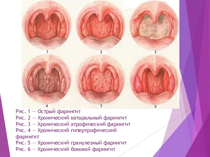 Рис. 1 — Острый фарингит Рис. 2 — Хронический катаральный