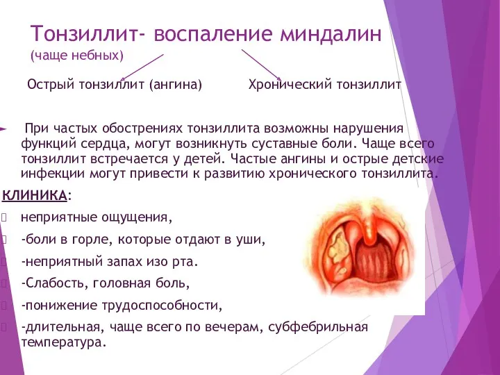 Тонзиллит- воспаление миндалин (чаще небных) Острый тонзиллит (ангина) Хронический тонзиллит