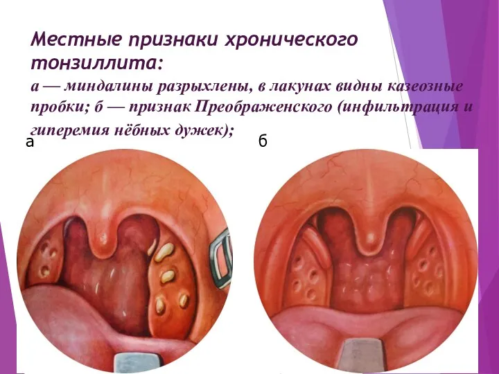 Местные признаки хронического тонзиллита: а — миндалины разрыхлены, в лакунах