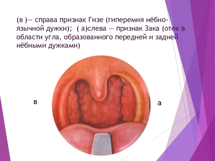 (в )— справа признак Гизе (гиперемия нёбно-язычной дужки); ( а)слева