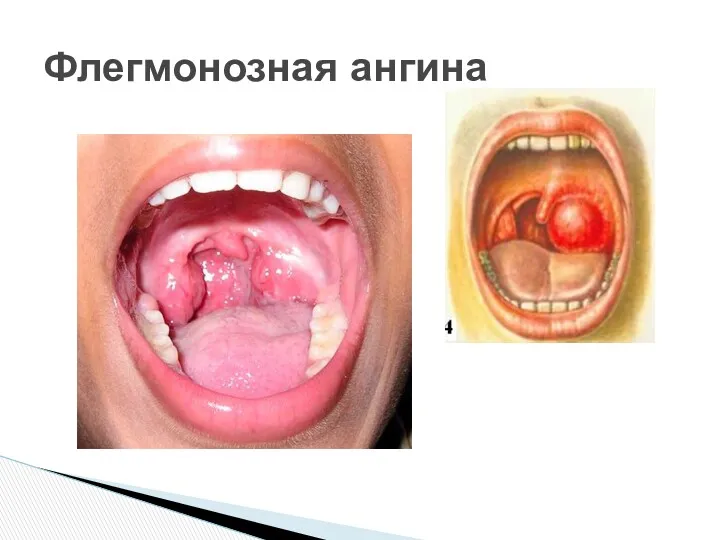 Флегмонозная ангина