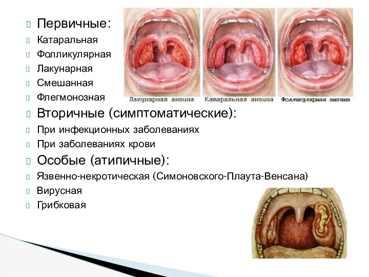 Первичные: Катаральная Фолликулярная Лакунарная Смешанная Флегмонозная Вторичные (симптоматические): При инфекционных