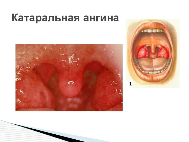 Катаральная ангина