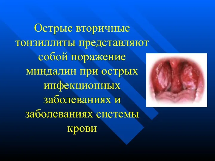 Острые вторичные тонзиллиты представляют собой поражение миндалин при острых инфекционных заболеваниях и заболеваниях системы крови