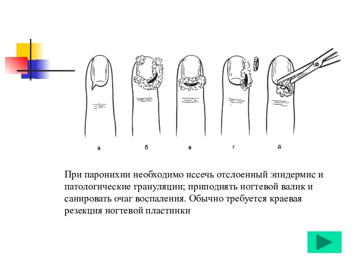 При паронихии необходимо иссечь отслоенный эпидермис и патологические грануляции; приподнять