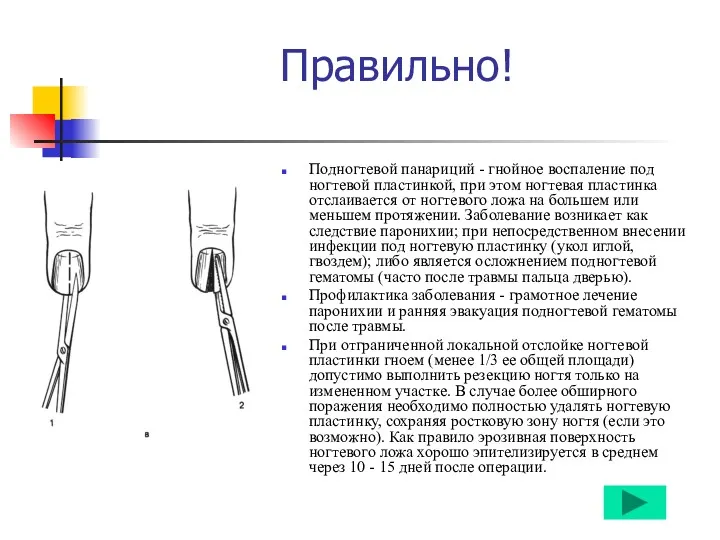 Правильно! Подногтевой панариций - гнойное воспаление под ногтевой пластинкой, при