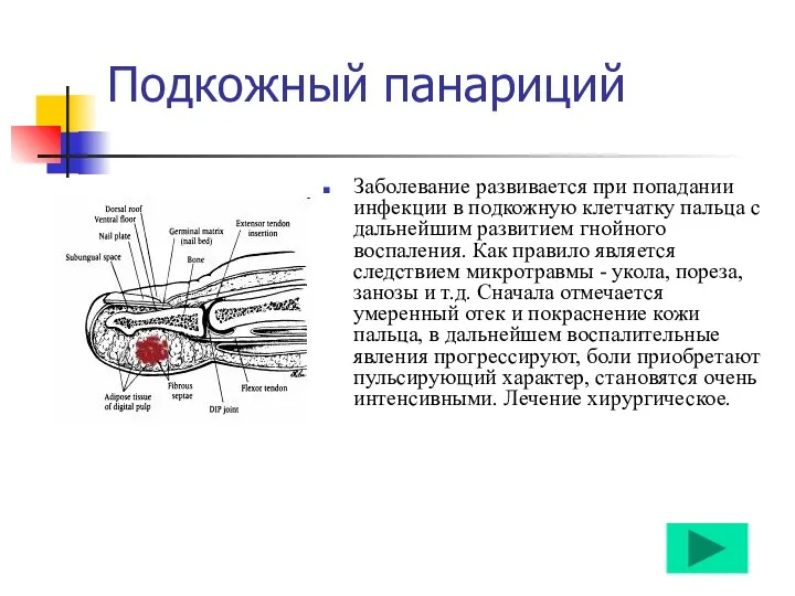 Подкожный панариций Заболевание развивается при попадании инфекции в подкожную клетчатку