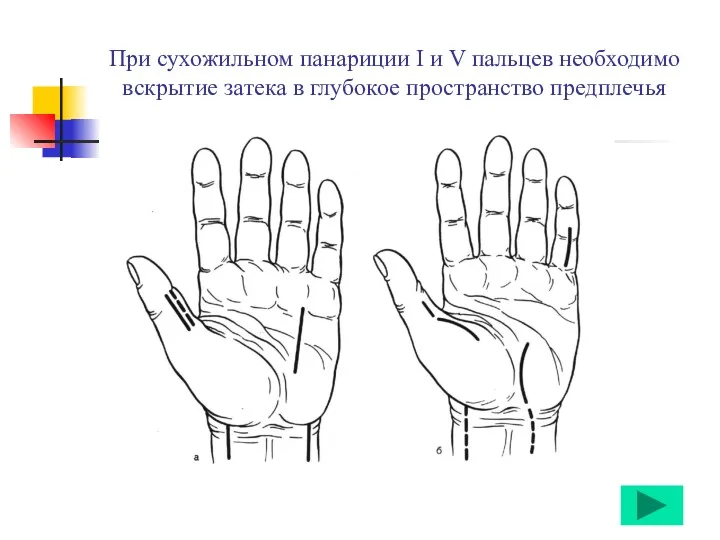 При сухожильном панариции I и V пальцев необходимо вскрытие затека в глубокое пространство предплечья