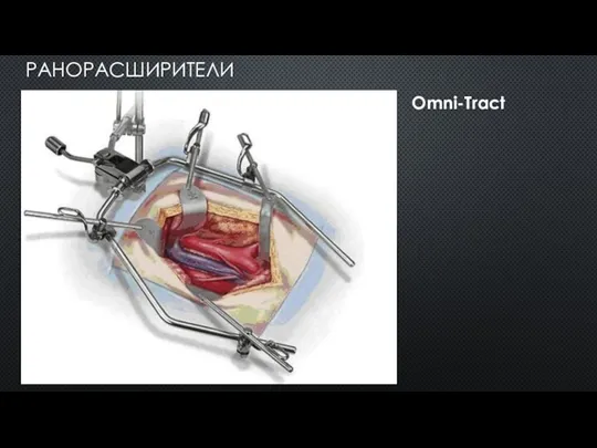 РАНОРАСШИРИТЕЛИ Omni-Tract