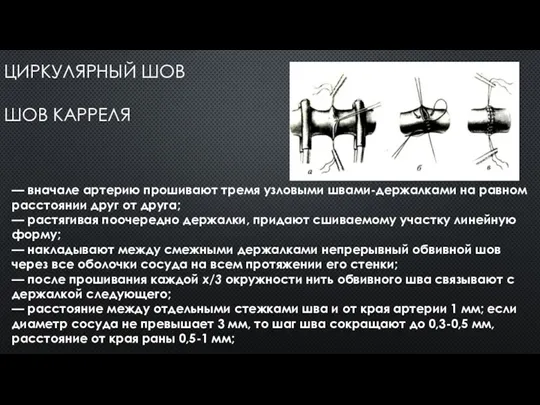 ЦИРКУЛЯРНЫЙ ШОВ ШОВ КАРРЕЛЯ — вначале артерию прошивают тремя узловыми