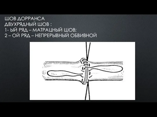 ШОВ ДОРРАНСА ДВУХРЯДНЫЙ ШОВ : 1- ЫЙ РЯД – МАТРАЦНЫЙ