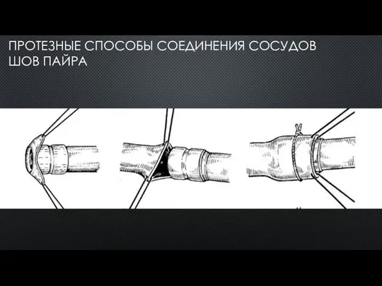 ПРОТЕЗНЫЕ СПОСОБЫ СОЕДИНЕНИЯ СОСУДОВ ШОВ ПАЙРА