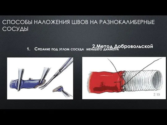 СПОСОБЫ НАЛОЖЕНИЯ ШВОВ НА РАЗНОКАЛИБЕРНЫЕ СОСУДЫ Срезание под углом сосуда меньшего диаметра 2.Метод Добровольской